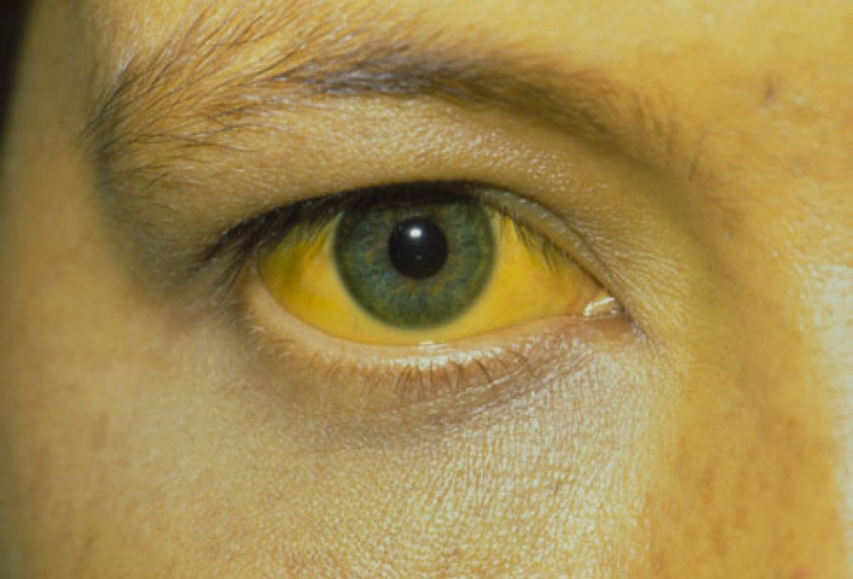 Vàng da, vàng mắt liên quan đến gan còn do nhiều bệnh lý liên quan đến mật